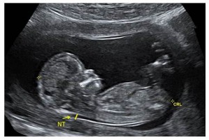 first trimester fetus showing crown rump length and nuchal translucency 